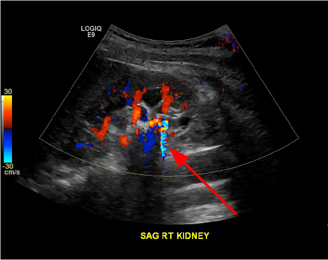 Ultrasound twinkle artifact image